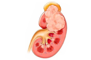 Опухоль левой почки у мужчины 42 лет
